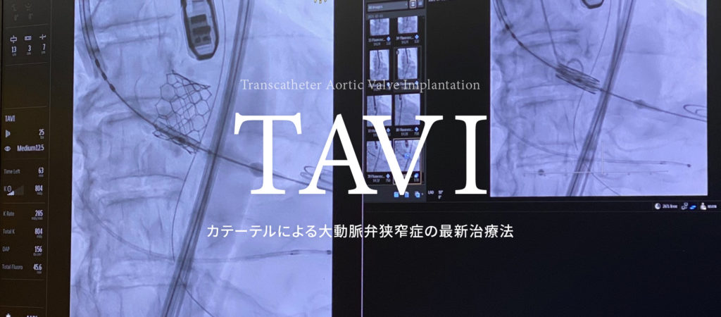 TAVI カテーテルによる大動脈弁狭窄症の最新治療法