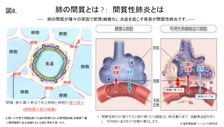 図8：肺の間質とは？：間質性肺炎とはの解説図